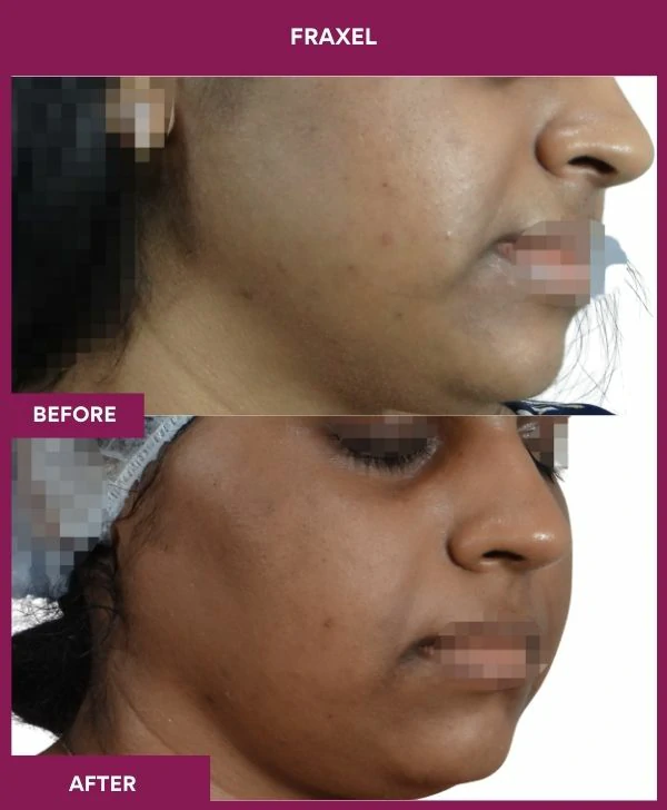fraxel-laser-treatment-before-after-results-mumbai-india-patient02-side-right