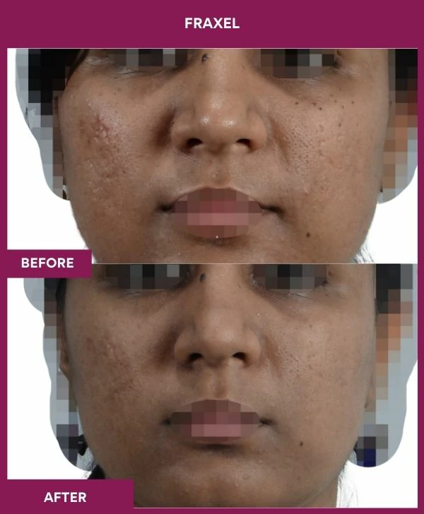 fraxel-laser-treatment-before-after-results-mumbai-india-patient04-front