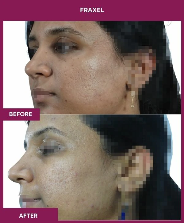 fraxel-laser-treatment-before-after-results-mumbai-india-patient04-side-left