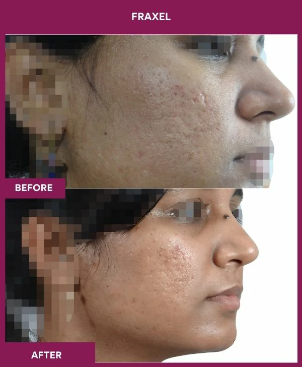 fraxel-laser-treatment-before-after-results-mumbai-india-patient04-side-right