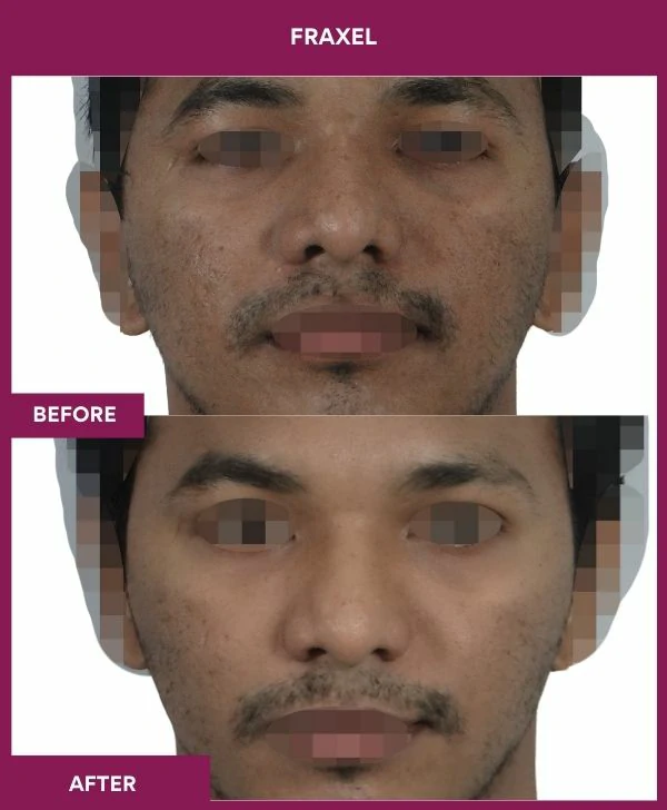fraxel-laser-treatment-before-after-results-mumbai-india-patient05-front
