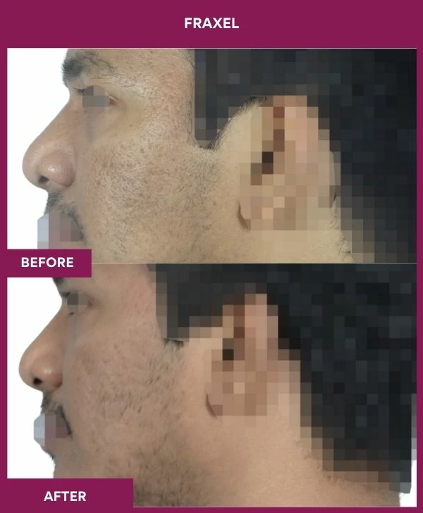 fraxel-laser-treatment-before-after-results-mumbai-india-patient05-side-left