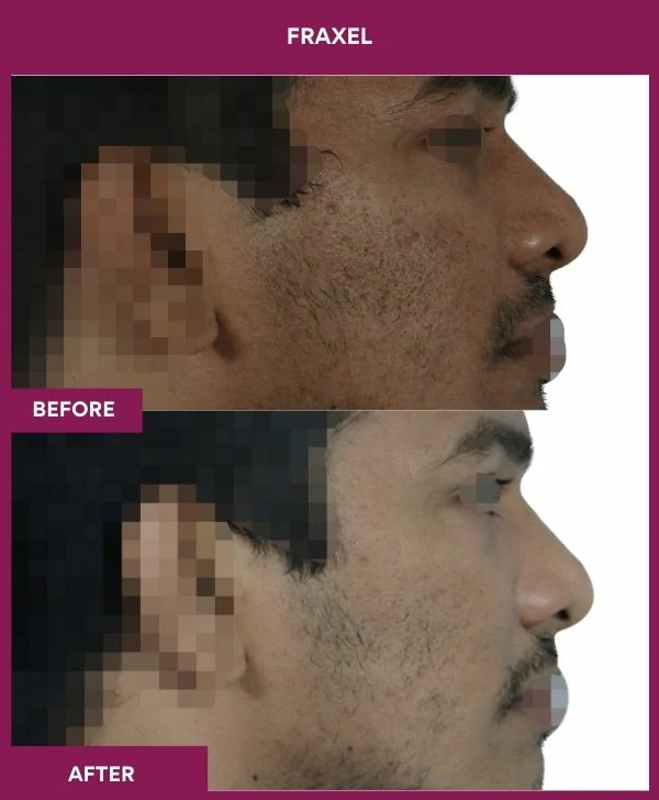 fraxel-laser-treatment-before-after-results-mumbai-india-patient05-side-right