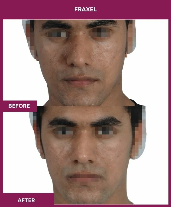 fraxel-laser-treatment-before-after-results-mumbai-india-patient06-front