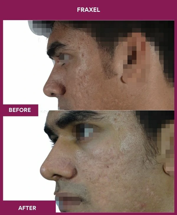 fraxel-laser-treatment-before-after-results-mumbai-india-patient06-side-left