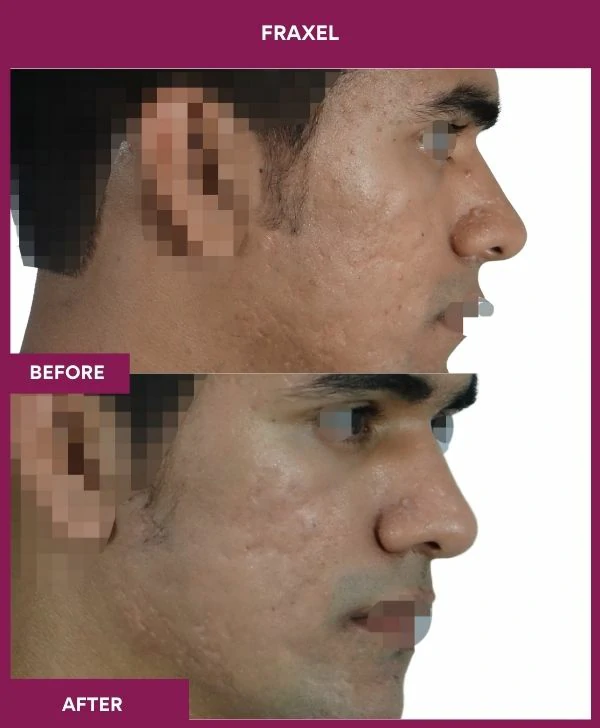 fraxel-laser-treatment-before-after-results-mumbai-india-patient06-side-right