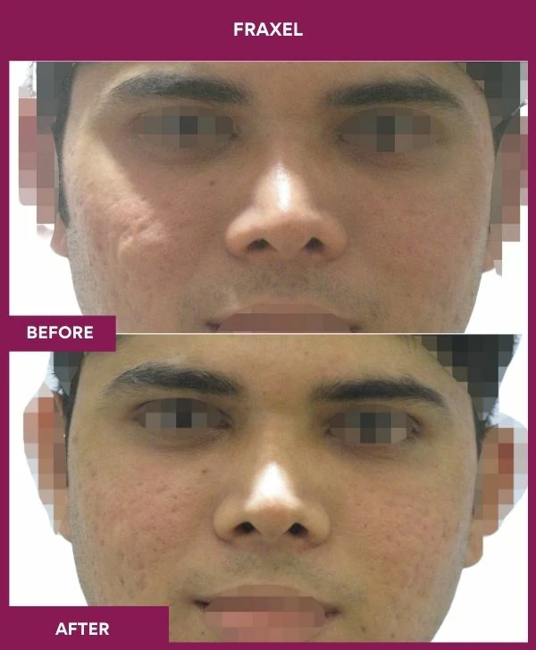 fraxel-laser-treatment-before-after-results-mumbai-india-patient07-front