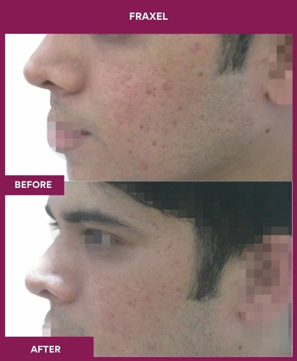 fraxel-laser-treatment-before-after-results-mumbai-india-patient07-side-left