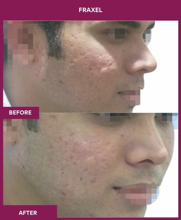 fraxel-laser-treatment-before-after-results-mumbai-india-patient07-side-right