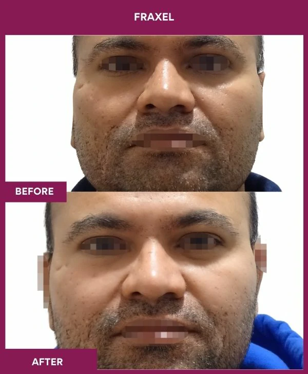 fraxel-laser-treatment-before-after-results-mumbai-india-patient08-front