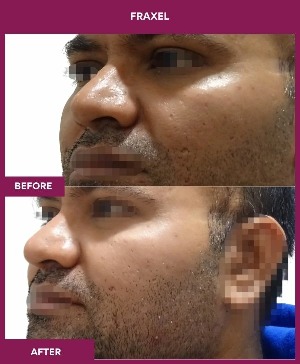 fraxel-laser-treatment-before-after-results-mumbai-india-patient08-side-left