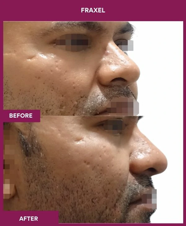fraxel-laser-treatment-before-after-results-mumbai-india-patient08-side-right