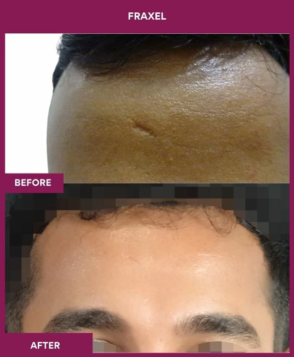 fraxel-laser-treatment-before-after-results-mumbai-india-patient09-front