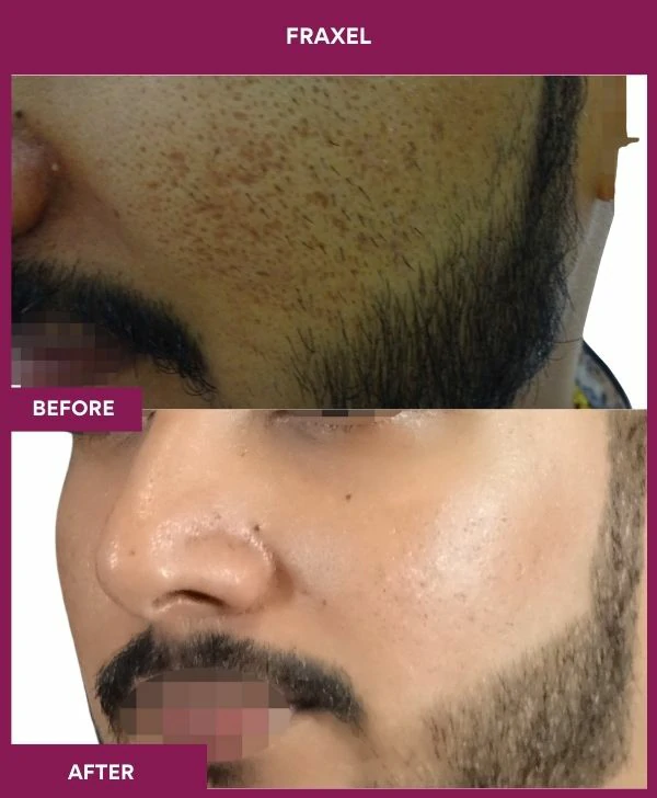 fraxel-laser-treatment-before-after-results-mumbai-india-patient09-side-left