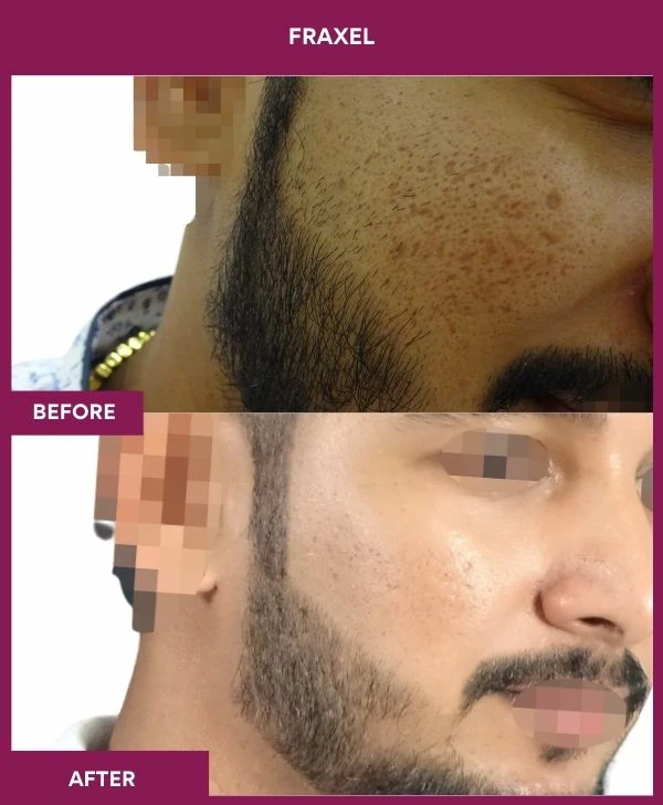 fraxel-laser-treatment-before-after-results-mumbai-india-patient09-side-right