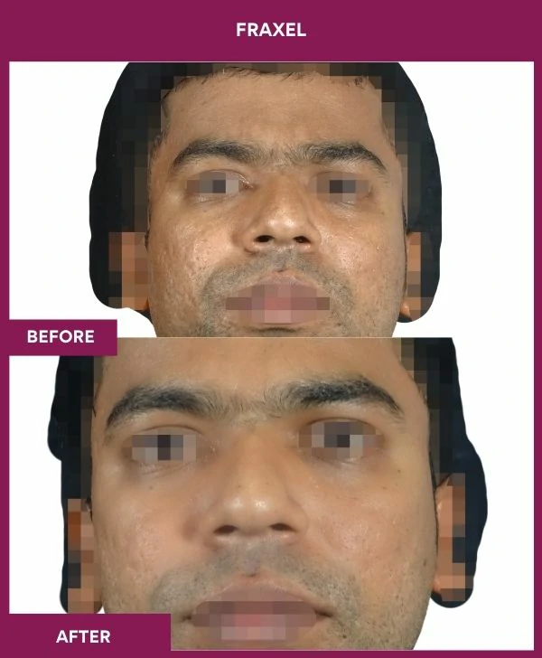 fraxel-laser-treatment-before-after-results-mumbai-india-patient10-front