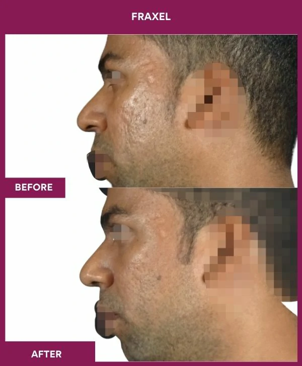 fraxel-laser-treatment-before-after-results-mumbai-india-patient10-side-left
