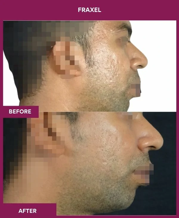 fraxel-laser-treatment-before-after-results-mumbai-india-patient10-side-right