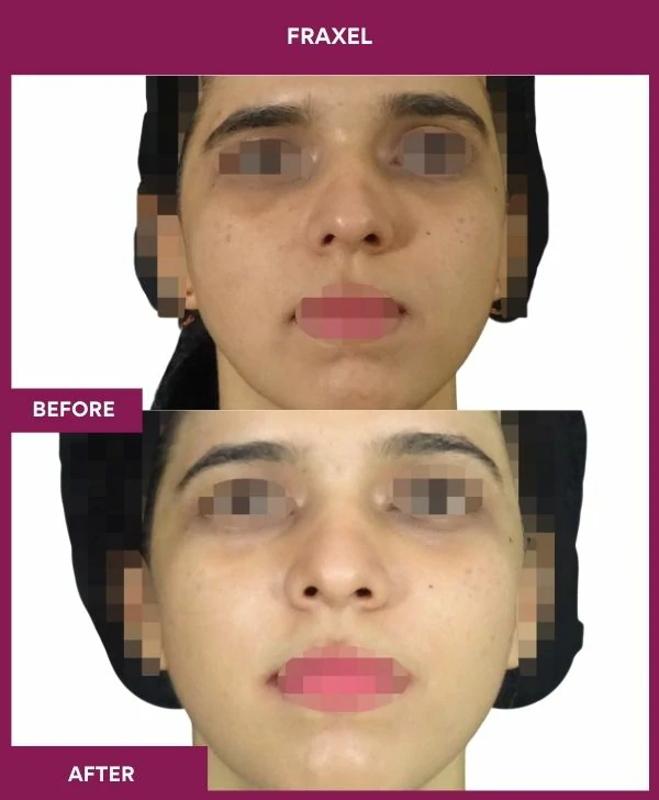 fraxel-laser-treatment-before-after-results-mumbai-india-patient11-front