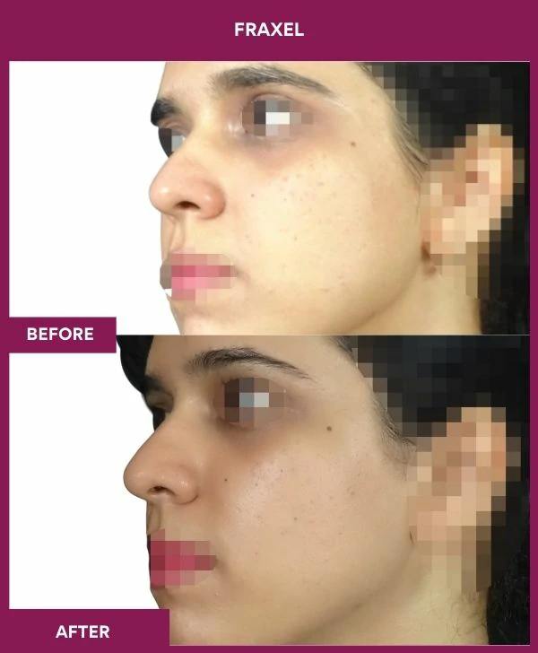 fraxel-laser-treatment-before-after-results-mumbai-india-patient11-side-left