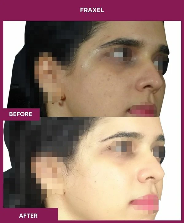 fraxel-laser-treatment-before-after-results-mumbai-india-patient11-side-right
