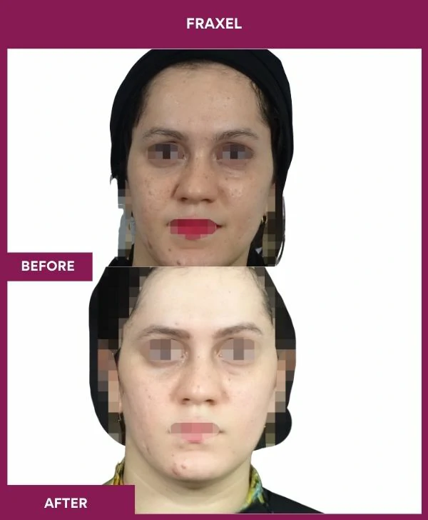 fraxel-laser-treatment-before-after-results-mumbai-india-patient12-front