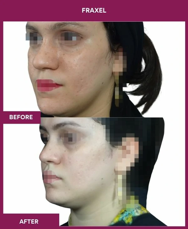 fraxel-laser-treatment-before-after-results-mumbai-india-patient12-side-left
