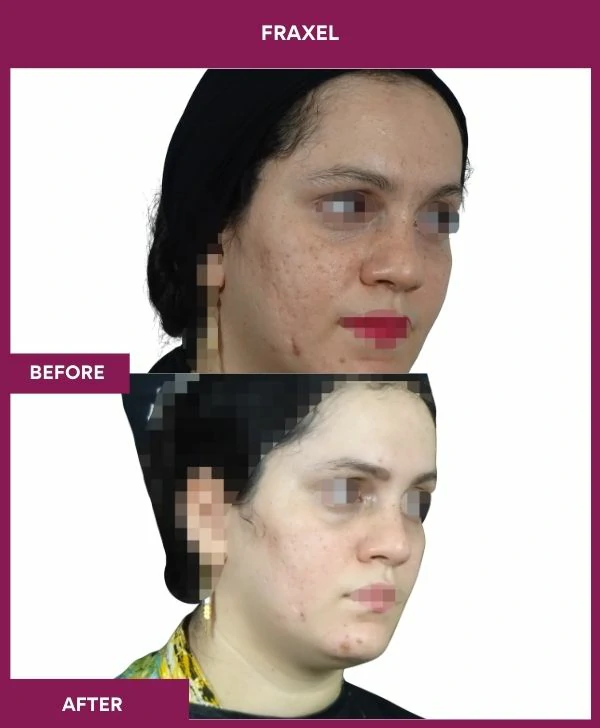 fraxel-laser-treatment-before-after-results-mumbai-india-patient12-side-right