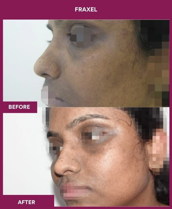 fraxel-laser-treatment-before-after-results-mumbai-india-patient13-side-left
