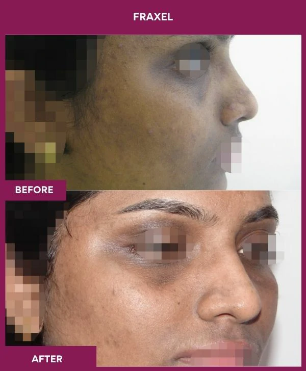 fraxel-laser-treatment-before-after-results-mumbai-india-patient13-side-right