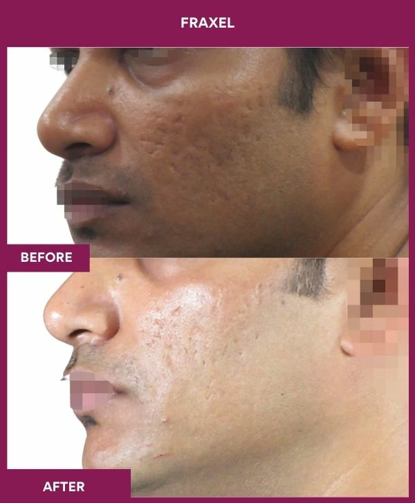 fraxel-laser-treatment-before-after-results-mumbai-india-patient14-side-left