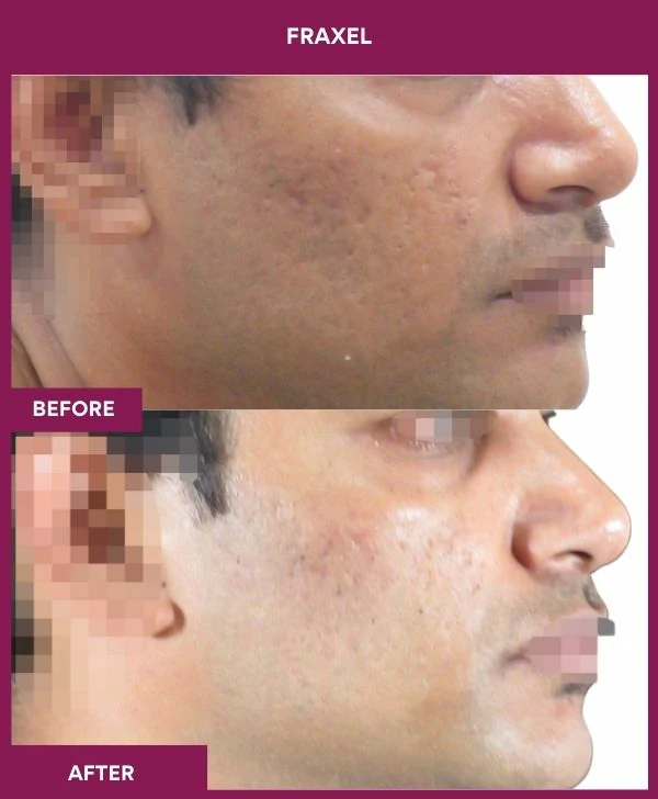 fraxel-laser-treatment-before-after-results-mumbai-india-patient14-side-right