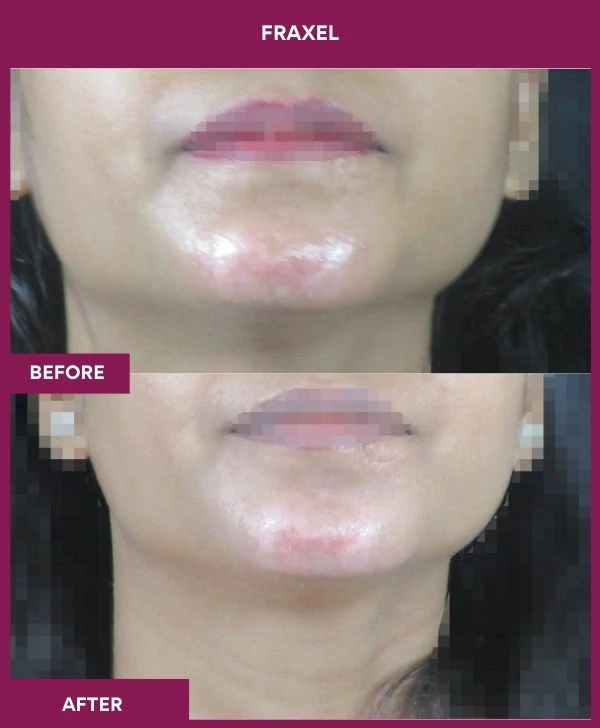 fraxel-laser-treatment-before-after-results-mumbai-india-patient15-front