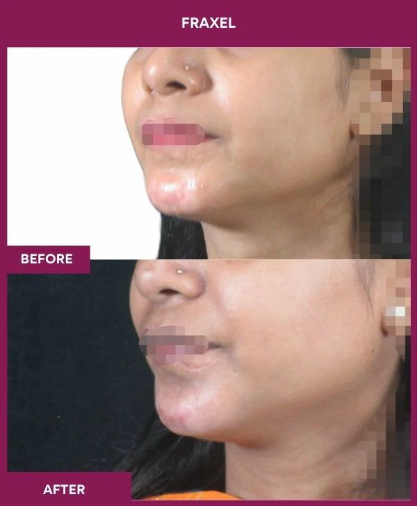 fraxel-laser-treatment-before-after-results-mumbai-india-patient15-side-left