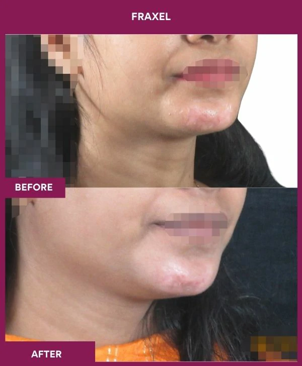 fraxel-laser-treatment-before-after-results-mumbai-india-patient15-side-right