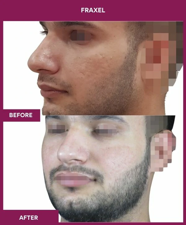 fraxel-laser-treatment-before-after-results-mumbai-india-patient16-side-left
