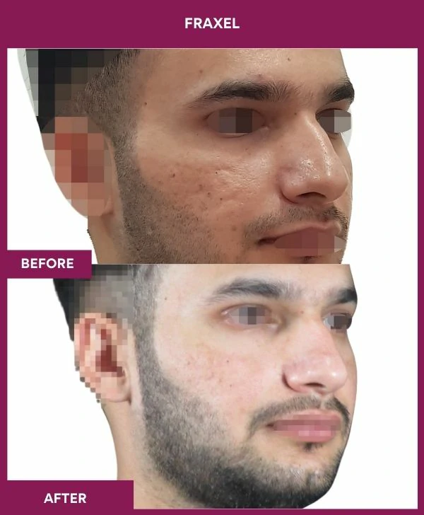 fraxel-laser-treatment-before-after-results-mumbai-india-patient16-side-right