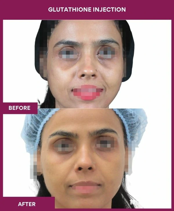 glutathione-injection-before-after-results-mumbai-india-patien26-face
