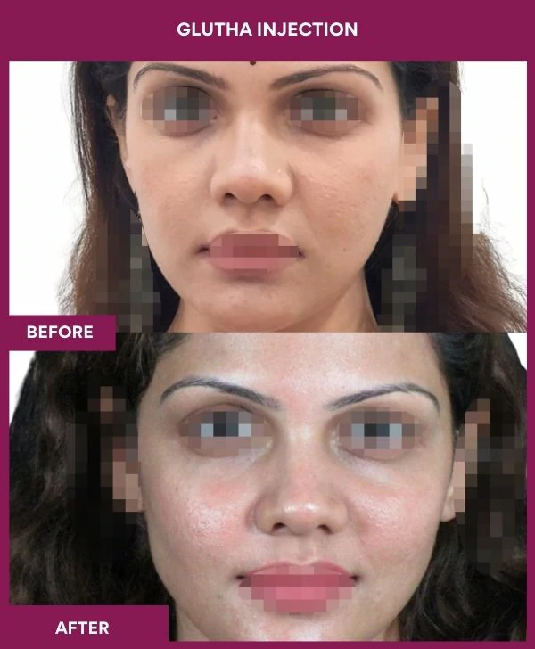 glutathione-injection-before-after-results-mumbai- india-patient01-face