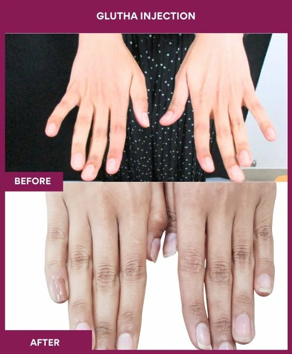 glutathione-injection-before-after-results-mumbai-india-patient01-hand