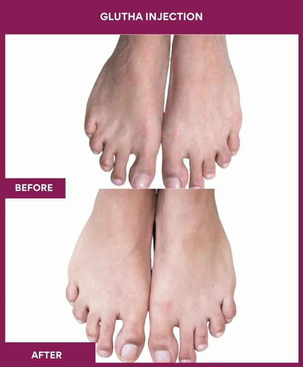 glutathione-injection-before-after-results-mumbai-india-patient01-leg