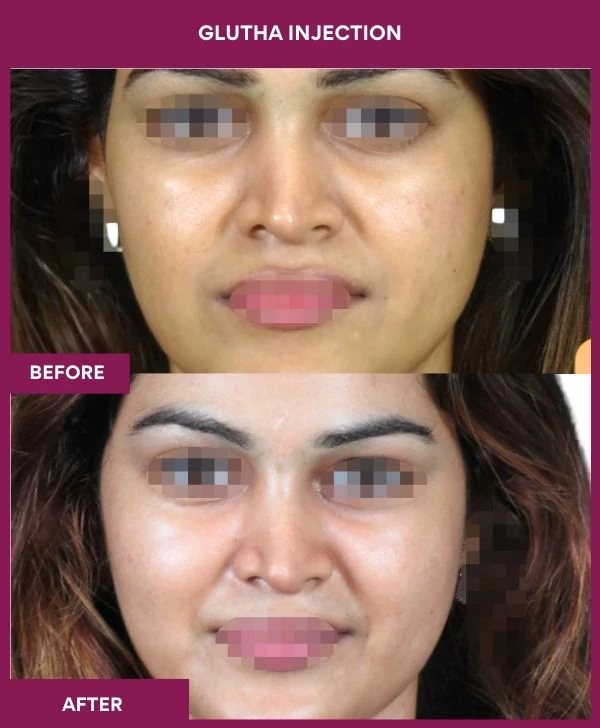 glutathione-injection-before-after-results-mumbai-india-patient02-face