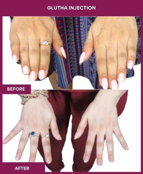glutathione-injection-before-after-results-mumbai-india-patient02-hand