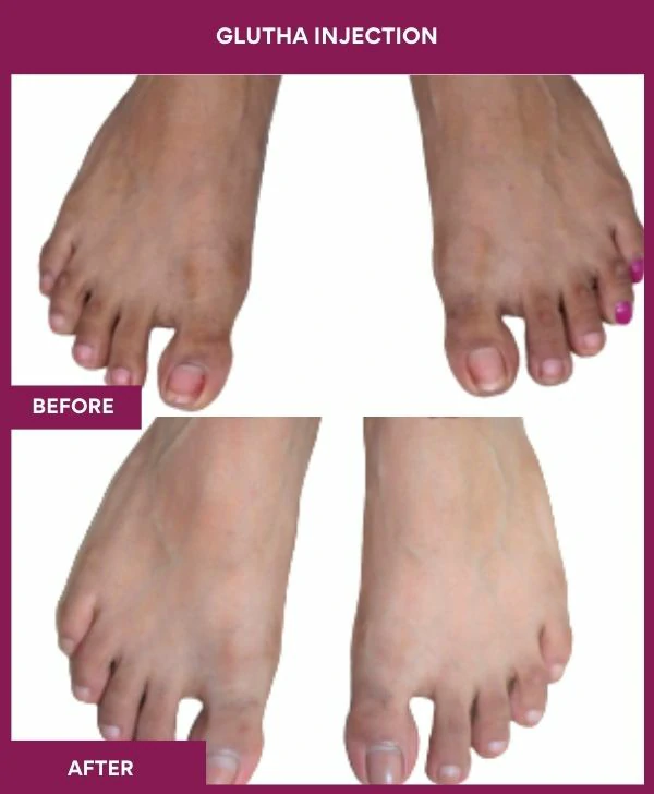 glutathione-injection-before-after-results-mumbai-india-patient02-leg