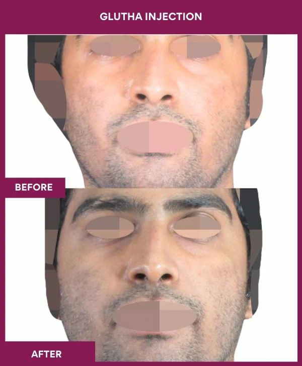glutathione-injection-before-after-results-mumbai-india-patient03-face