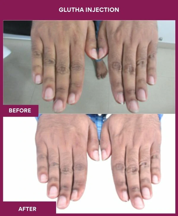 glutathione-injection-before-after-results-mumbai-india-patient03-hand