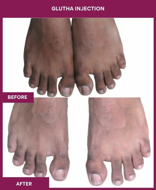 glutathione-injection-before-after-results-mumbai-india-patient03-leg