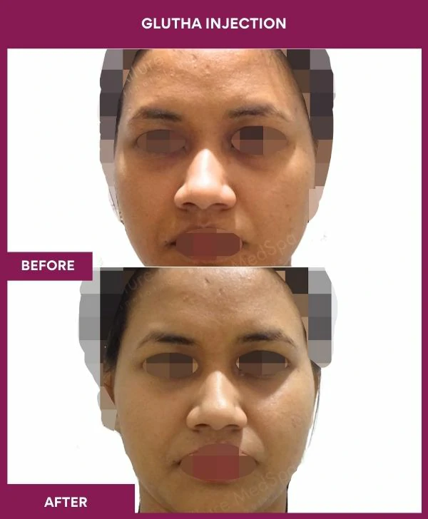 glutathione-injection-before-after-results-mumbai-india-patient04-face
