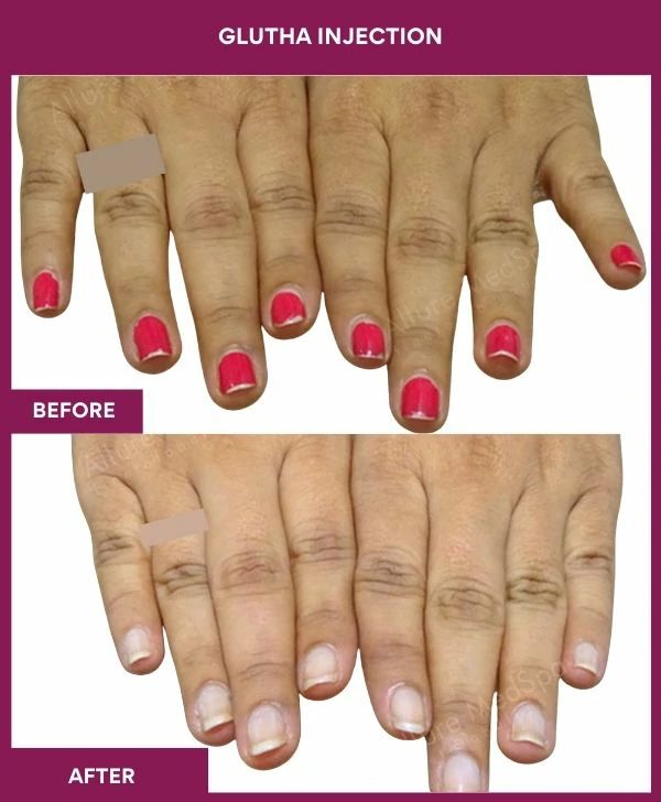 glutathione-injection-before-after-results-mumbai-india-patient04-hand