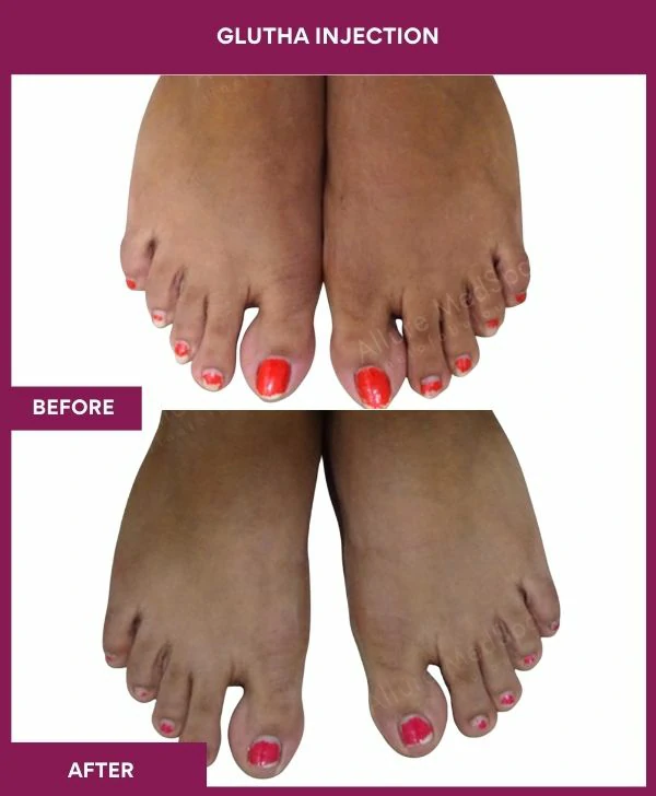 glutathione-injection-before-after-results-mumbai-india-patient04-leg